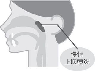 慢性上咽頭炎の説明図・白黒・シンプルな図解_イラスト