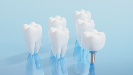 Dental Implants surgery concept, dentistry denture, Dental denture on blue background. 3D render.