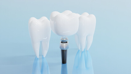 Dental Implants surgery concept, dentistry denture, Dental denture on blue background. 3D render.