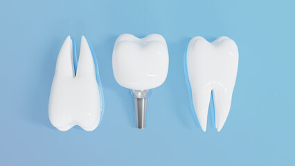 Dental Implants surgery concept, dentistry denture, Dental denture on blue background. 3D render.