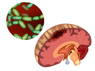 Bacterial Meningitis Illustration. Brain Infection and Bacteria  Medical Anatomy Diagram. Brain Cross-Section with Pathogenic Bacteria