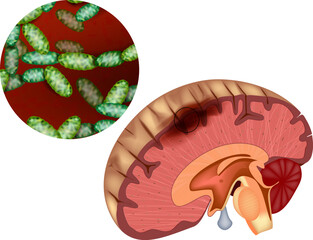 Bacterial Meningitis Illustration. Brain Infection and Bacteria  Medical Anatomy Diagram. Brain Cross-Section with Pathogenic Bacteria