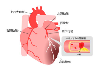 心筋梗塞を起こした心臓の血栓の説明入りイラスト
