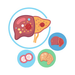 Liver Damage: Fatty Liver, Fibrosis, Cirrhosis