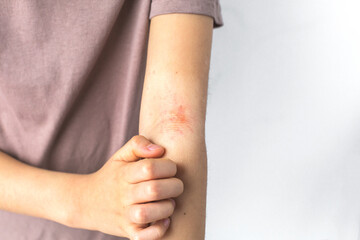 Child scratching their arm with visible redness and rash, indicating eczema, dermatitis, or an...