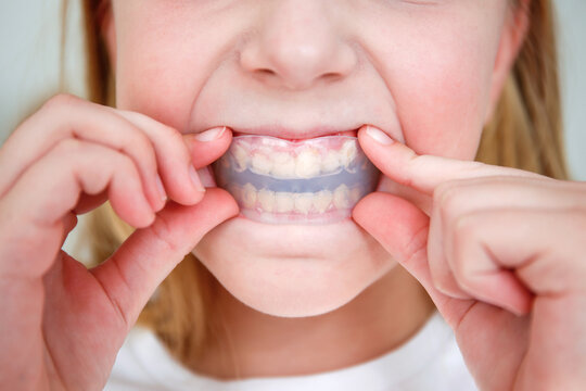 Dental simulator for teeth alignment . The child has mouth guards on his teeth.