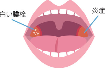 扁桃炎の説明図・説明イラスト素材