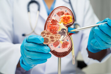 Chronic kidney disease, doctor with model for treatment urinary system, urology, Estimated...