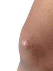 Fototapeta premium Close-Up of Bacterial Infected Skin Lesion on Knee of Dark Skin Individual