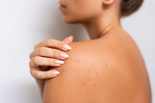 Red rash on the female back. Young woman touching her shoulder showing skin with acne problem on a white background. Allergies, pimples, hormonal changes. Sweating sickness, prickly heat, sun effect