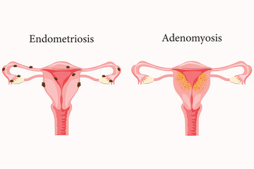 illustration of adenomyosis and endometriosis. medical illustration
