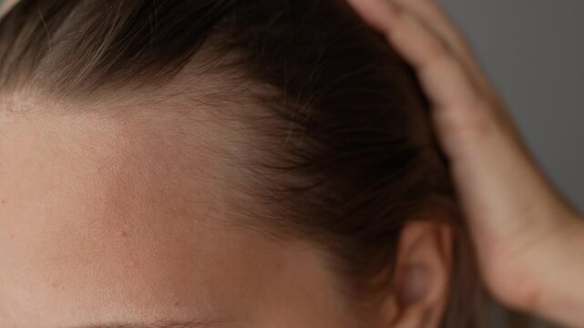 Close-up of a young blonde woman showing receding hairline on her forehead and temples pushing hair back with her hand. Hair care. A girl demonstrating a healthy scalp and the absence of dandruff