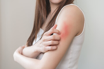 Dermatology asian young woman, girl allergy, allergic reaction from atopic, insect bites on arm,...