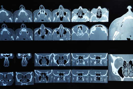 X-ray image of paranasal sinuses as background