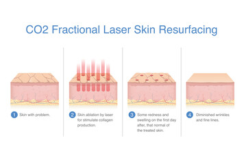 Steps of problem skin treatment with CO2 fractional laser to skin resurfacing. Skin ablation by laser energy for stimulate new collagen and elastin production.