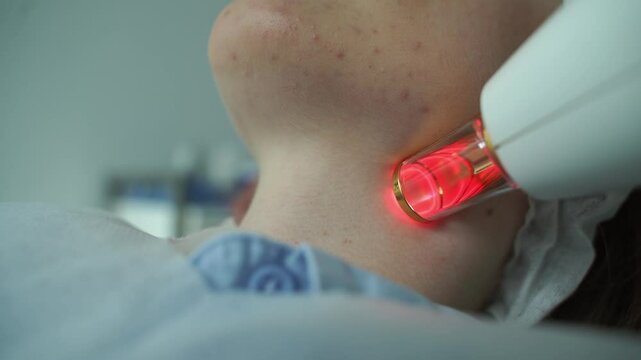 Rosacea treatment with IPL laser equipment in clinic 4k video. Removal vessels in the neck zone with IPL device by beautician. Quick rosacea treatment by high quality laser devices.