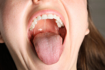 Closeup view of woman's oral cavity. Sore throat