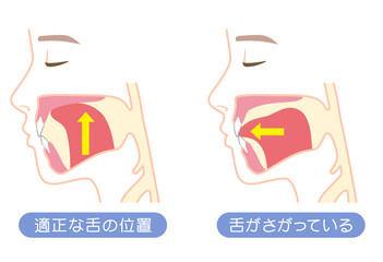 正しい舌の位置と下がっている舌の位置　ミューイング © koti