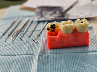 Dental decay model shows progress of decay. An example of dental disease. Dentistry. Caries on the...