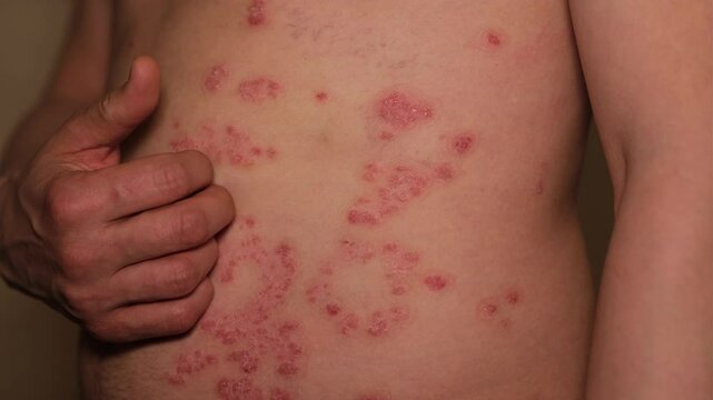 Understanding psoriasis and its impact on skin health with expert insights and care tips