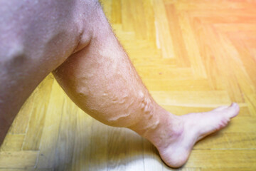 Varicose veins. Phlebology and DVT. Varicose veins on leg of man. Varicosity on legs, spider veins,...