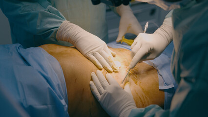 Two doctors men surgeon physician medic help patient operate plastic surgery abdomen belly...