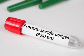 Prostate specific antigen (PSA) test name of blood test