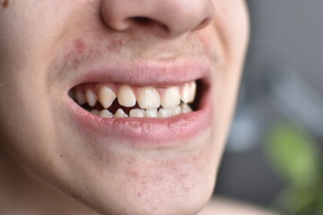 plaque on the teeth of a teenager in close-up. oral hygiene.