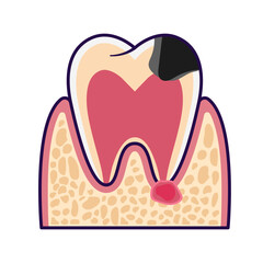 dental abcess disease