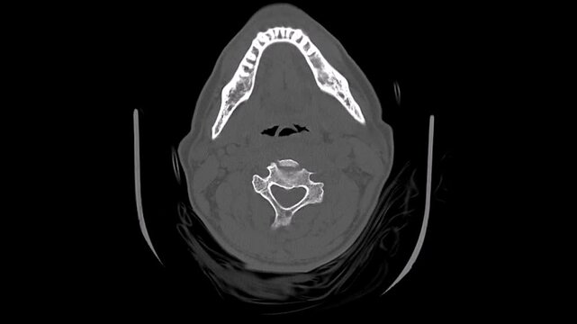 A Jefferson fracture  ct scan image ,cervical fracture ,The cervical spine videos 	