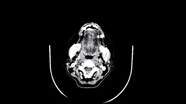 A CT scan of the brain , show large brain infarctions caused by embolic strokes
