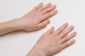 Child shows hands with warts on skin, at doctor's appointment on white background. Pediatric dermatology concept. Papillomavirus. Verruca vulgaris. HPV.