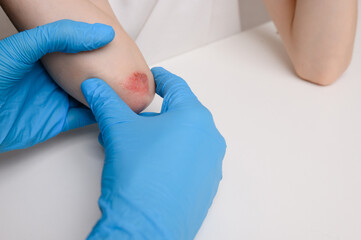 Doctor carefully examines child's elbow at reception, with inflamed red areas of skin. Child...
