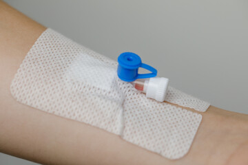 Peripheral venous catheter in human arm close-up on white background