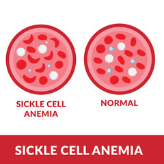 Sickle cell disease. The difference of Normal red blood cell and sickle cell