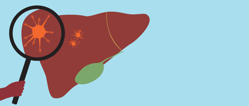 Liver with malignant tumor as oncology concept, flat vector stock illustration or copy space template with liver cancer