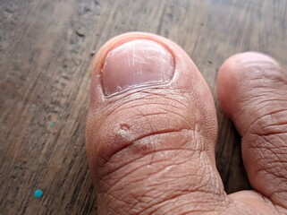 big toe with a little wound, big toenail