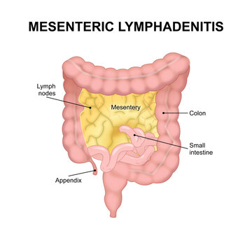 Mesenteric lymphadenitis Illustration lymph node