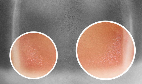 A woman with reddened, itchy skin after sunburn on white isolated background. Skin care and protection from the sun's ultraviolet rays.