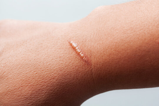 Large scar on human body close-up. Skin scar removal.