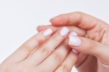 A woman has a wart on her little finger. Treatment of warts with liquid nitrogen.