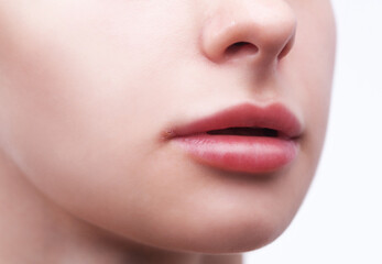 Woman showing herpes disease on her lips. Treatment of viral infections.