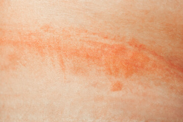 Great irritation on human skin. Treatment of skin rash on the body.