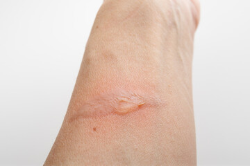 First degree burn on arm with grey background. Fluid filled wound with puss and discharge. Burned...