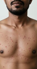 Close-Up of Man's Chest Showing Multiple Acne Lesions and Scars