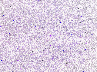 Peripheral blood smea, the red blood cells (RBCs) show anisocytosis, poikilocytosis, hypochromia and target cells may be due to the Iron deficiency anemia, Thalassemia or Liver disease.