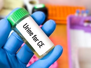 Microbiologist holding urine sample Urine Cultural Examination (CE) test.