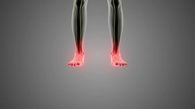Foot Discomfort Due to Guillain Barre Syndrome