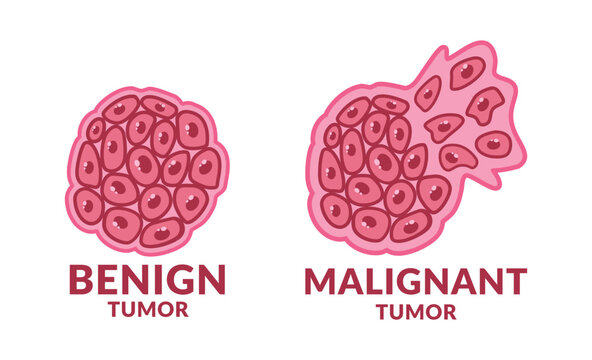 Benign and Malignant Tumor Cancer Cell design vector illustration