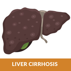 Illustration of Liver Disease Cirrhosis